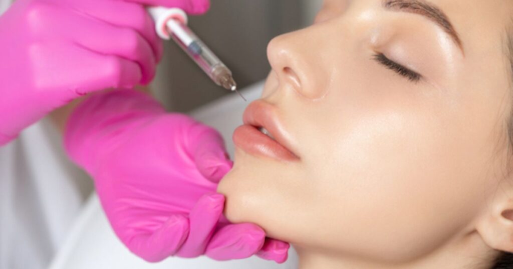 Achieving Natural Results with Ourself Lip Fillers