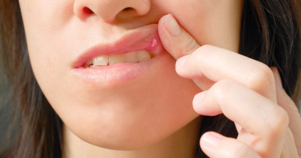 Causes of Lip Filler Migration
