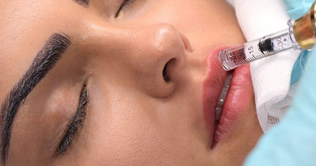 Choosing Needleless Lip Fillers Factors to Consider