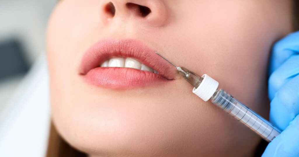 Exploring the Pain Factor in Lip Filler Procedures