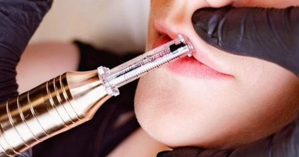 How Needleless Lip Fillers Work