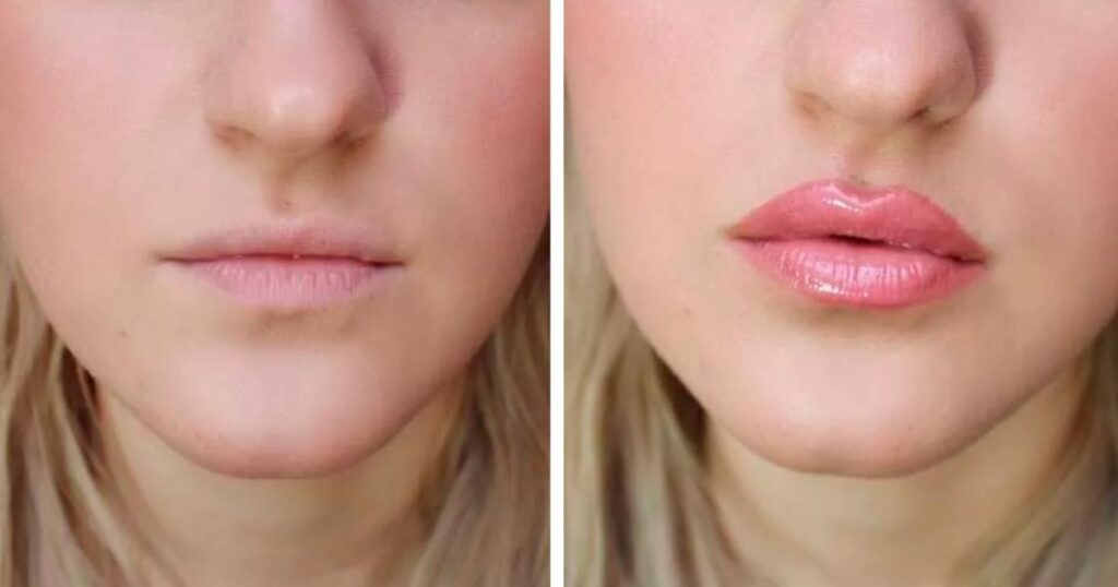 Long-Term Effects and Maintenance of Russian Lip Fillers