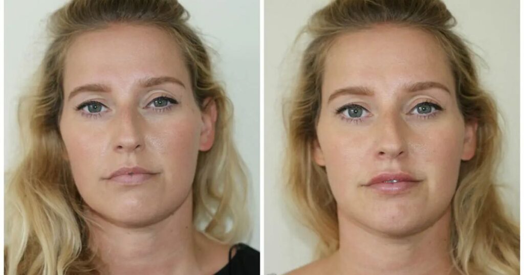 Pain Levels and Lip Augmentation What to Expect