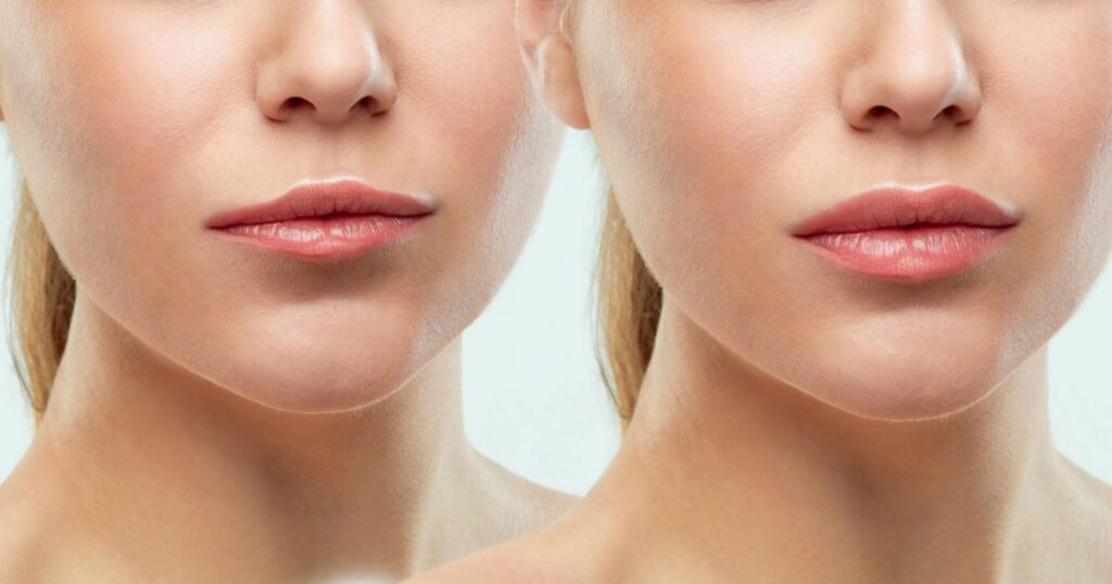 Signs and Symptoms of Lip Filler Migration
