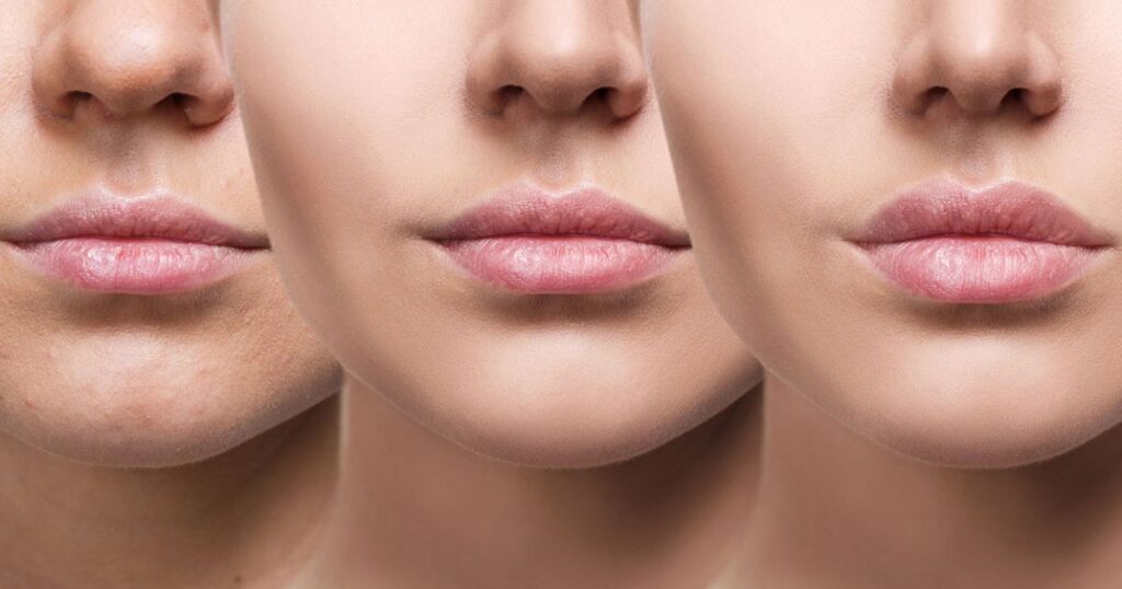 Subtle Lip Fillers vs. Bold Enhancements Making the Choice
