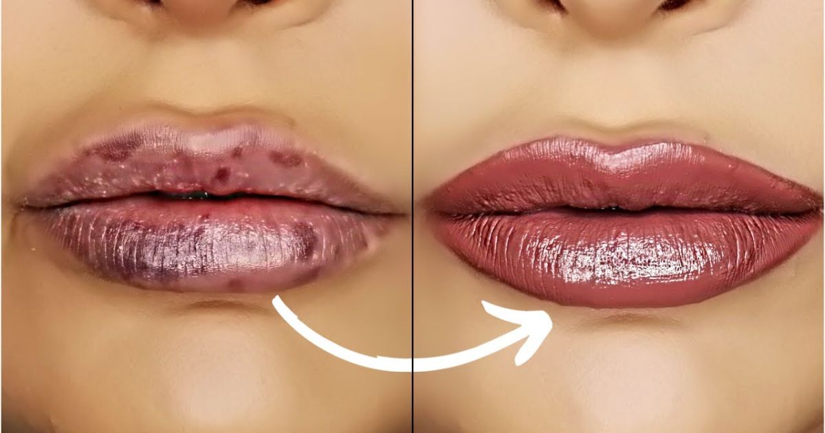 Injecting Half a Syringe of Lip Filler