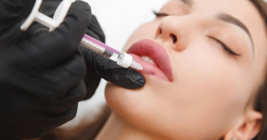 Long-Term Care for Lip Fillers