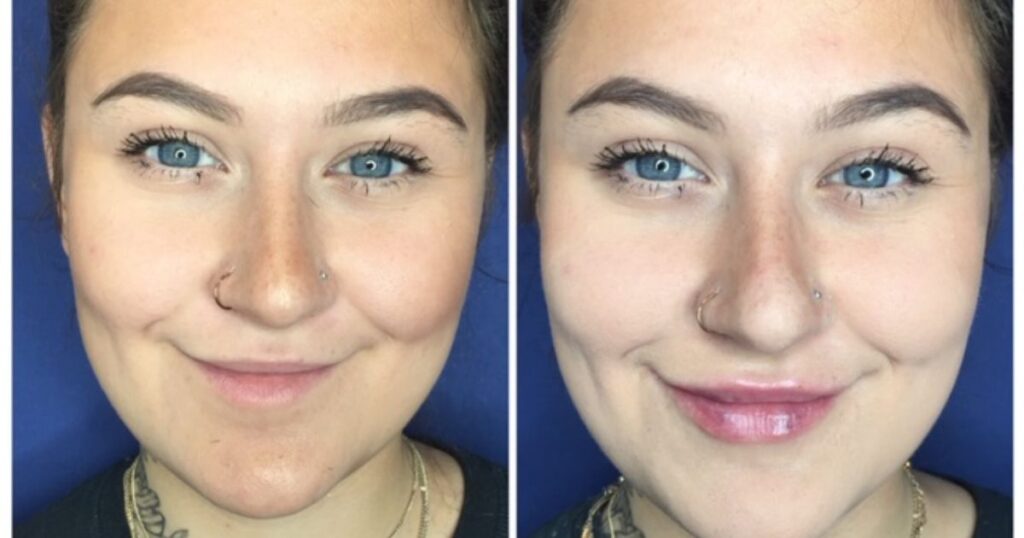 Results and Expectations from Lip Fillers