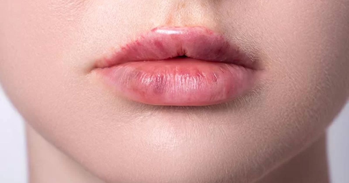 Lip Filler Bruising