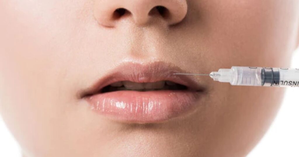 The Science Behind 1 Syringe Lip Enhancement