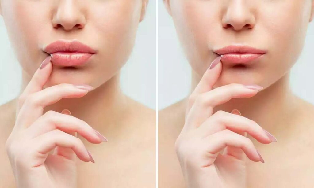 Exploring the 4 Lip Filler Types: