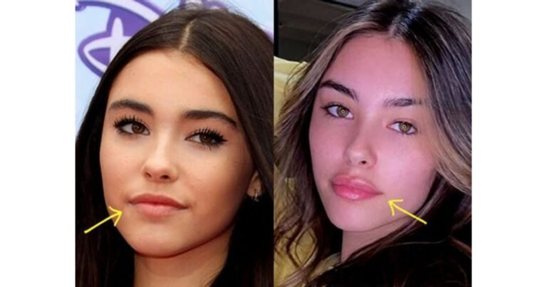 Did Madison Beer Have Plastic Surgery